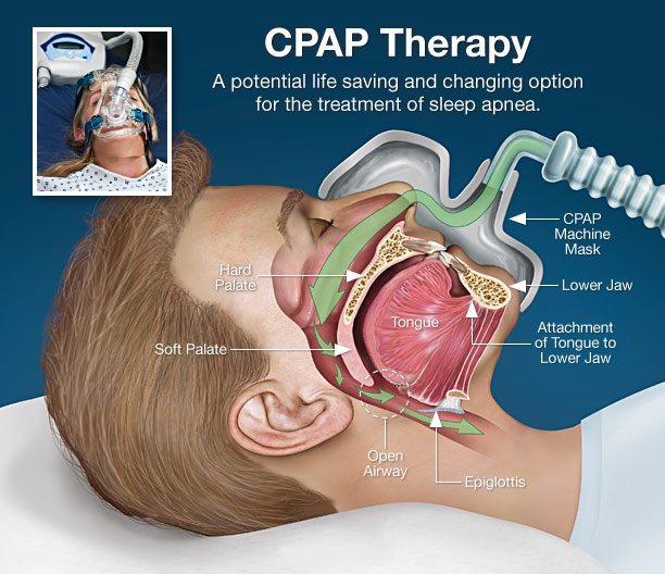 cpap-therapy.jpg