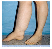 Lymphedema