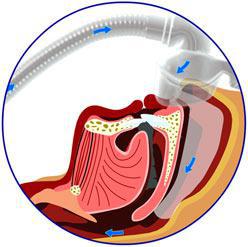 CPAP