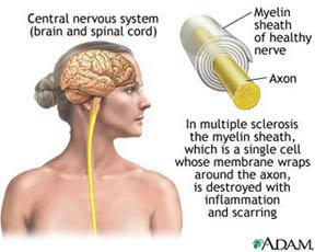 Ms Multiple Sclerosis Lincoln Medical Supply Pleasantville, NJ (609) 641-4050